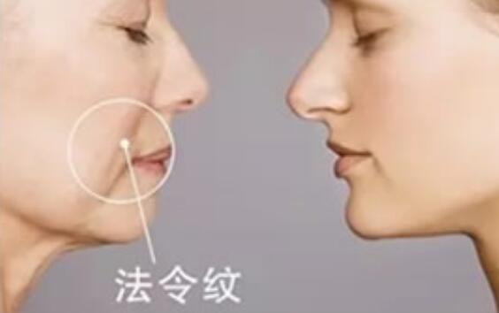 改善法令紋美容儀：科技創(chuàng)新，讓你重塑年輕容顏！