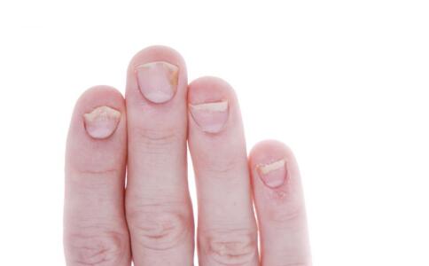 輕松擁有光滑肌膚：祛痘印小妙招讓你告別痘痕！