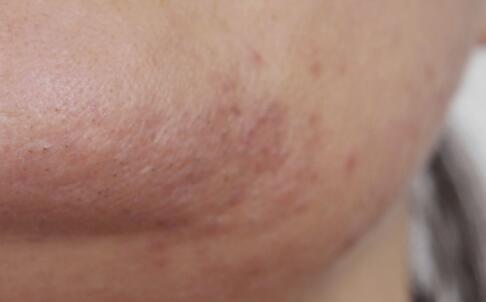 黃褐斑對我們產(chǎn)生的影響有哪些