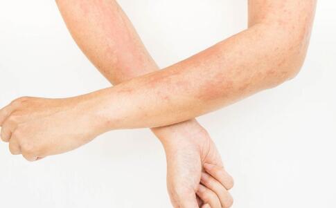 原來(lái)臉上的色斑就是這樣來(lái)的