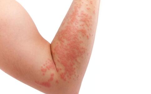 色斑怎么辦 色斑的解決方法有哪些呢