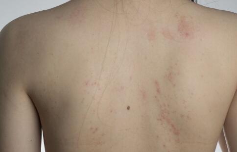 女性臉上長斑究竟是什么原因