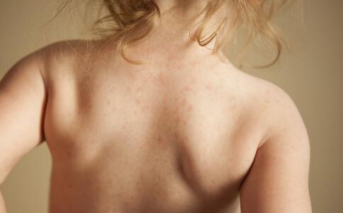 色斑形成原因與飲食