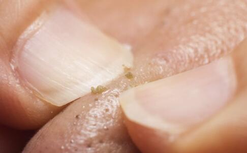 祛斑的方法 趕走色斑不做斑女郎