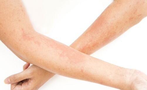 各種色斑的形成原因以及特點(diǎn)