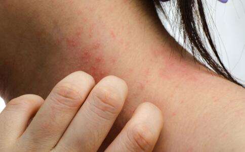 最簡單的祛痘方法