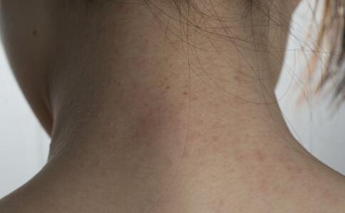 祛痘最快的方法 “痘”花妹不可不看四個(gè)祛痘方法