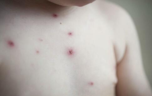 夏季祛痘最有效的9個(gè)方法