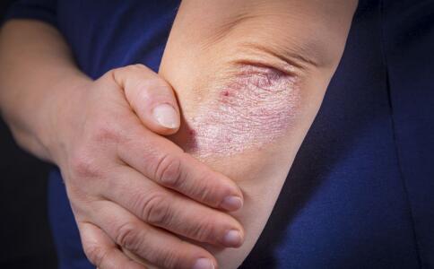 日常祛痘的方法幫你快速搞定痘痘