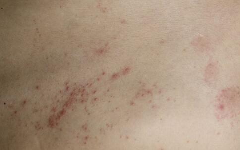 祛痘產(chǎn)品哪個(gè)好 各方人士共同推舉祛痘產(chǎn)品中的明星