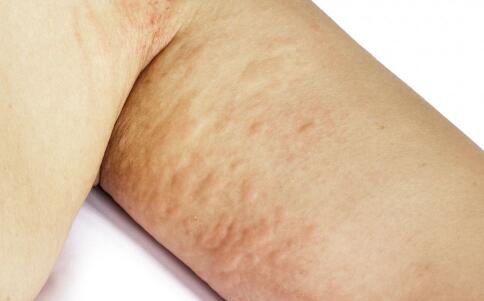 祛痘比較好的產(chǎn)品 讓痘痘不再成為你的苦惱