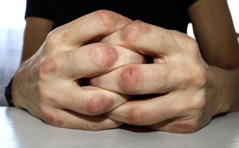 中藥祛痘配方再不知道，就追悔莫及