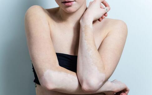 白斑的病因有哪些