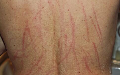 怎樣徹底去除臉上色斑