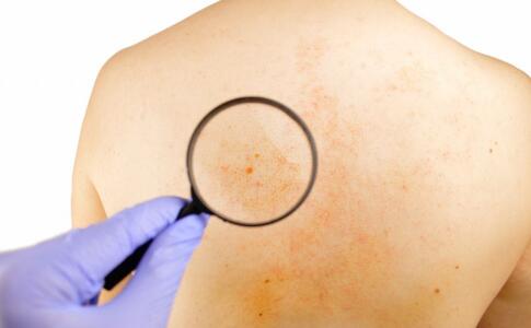 專家：使用果酸加速皮膚老化