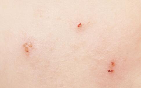 哪些因素會增長皺紋