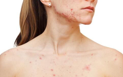 油性皮膚該如何抗衰老