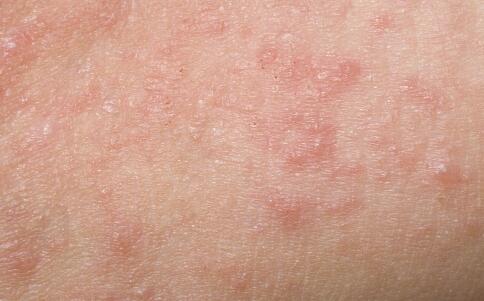 日常如何保養(yǎng)防治皺紋