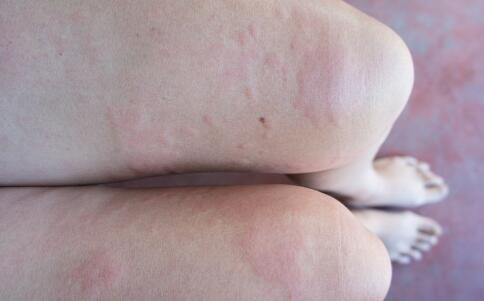 女性臉上皺紋多 吃什么有利除皺